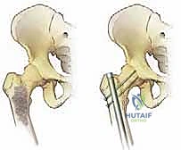 توضيح لانتشار الخلايا السرطانية في العظام