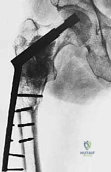 صورة توضيحية لـ استبدال مفصل الورك الكلي لآفات السرطان النقيلي: دليل شامل للمرضى في اليمن