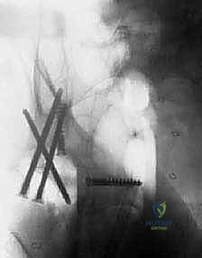 صورة توضيحية لـ استبدال مفصل الورك الكلي لآفات السرطان النقيلي: دليل شامل للمرضى في اليمن