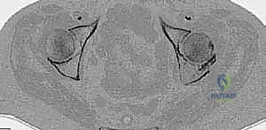 صورة طبية: استبدال مفصل الورك الكلي لآفات السرطان النقيلي: دليل شامل للمرضى في اليمن