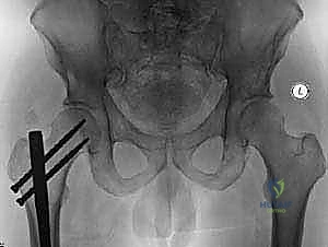 صورة توضيحية لـ استبدال مفصل الورك الكلي لآفات السرطان النقيلي: دليل شامل للمرضى في اليمن