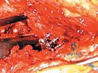 صورة طبية: استبدال مفصل الورك الكلي لآفات السرطان النقيلي: دليل شامل للمرضى في اليمن