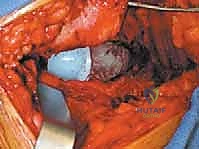 صورة توضيحية لـ استبدال مفصل الورك الكلي لآفات السرطان النقيلي: دليل شامل للمرضى في اليمن