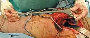 صورة توضيحية لـ استبدال مفصل الورك الكلي لآفات السرطان النقيلي: دليل شامل للمرضى في اليمن