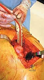 صورة طبية: استبدال مفصل الورك الكلي لآفات السرطان النقيلي: دليل شامل للمرضى في اليمن