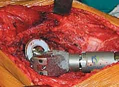Illustration of arthroplasty for malignant - Dr. Mohammed Hutaif
