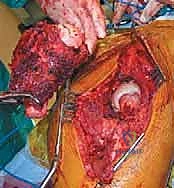 صورة طبية: استبدال مفصل الورك الكلي لآفات السرطان النقيلي: دليل شامل للمرضى في اليمن