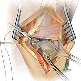 DRUJ Stabilization: Masterclass in Intra-Articular Radioulnar Ligament Reconstruction