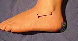 تثبيت المفصل تحت الكاحل المعزول: حل دائم لآلام القدم المزمنة مع الأستاذ الدكتور محمد هطيف