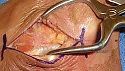 صورة توضيحية لـ تثبيت المفصل تحت الكاحل المعزول: حل دائم لآلام القدم المزمنة مع الأستاذ الدكتور محمد هطيف