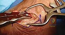 صورة توضح تورم وأعراض تلف المفصل