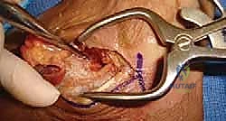 صورة توضح نخر العظام اللاوعائي