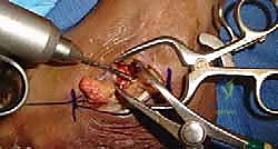 تصوير مقطعي محوسب يوضح التفاصيل الدقيقة للتلف