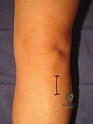 صورة توضيحية لـ تثبيت المفصل تحت الكاحل المعزول: حل دائم لآلام القدم المزمنة مع الأستاذ الدكتور محمد هطيف