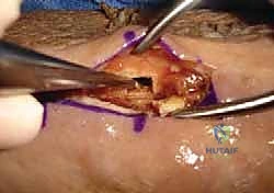 صورة توضح مرحلة التأهيل والعلاج الطبيعي