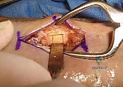 صورة توضح استخدام التقنيات الحديثة والأشعة التداخلية