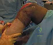 Knee Arthrofibrosis Release: An Intraoperative Masterclass for Restoring Motion