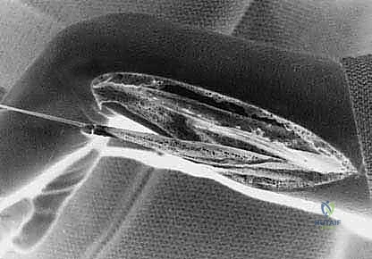 توضيح تأثير الشلل الدماغي على وضعية الرسغ وانقباض العضلات