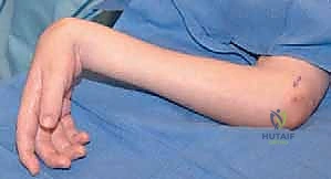 خطوات جراحة نقل وتر قابضة الرسغ الزندية إلى باسطة الرسغ