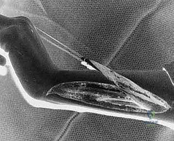 العلاج الطبيعي وإعادة التأهيل بعد جراحة نقل أوتار الرسغ