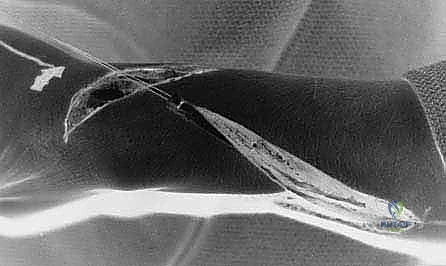 النتائج الوظيفية وتحسن حركة اليد بعد عملية نقل الوتر