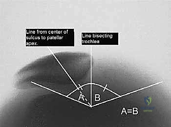 Arthroscopic Lateral Retinacular Release: An Intraoperative Masterclass