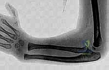 Illustration of side of the wrist - Dr. Mohammed Hutaif