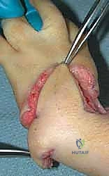 تصنيف وأنواع نقص تنسج الكعبرة والتشوهات المصاحبة