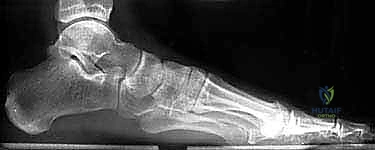 الميكانيكا الحيوية للمفصل تحت الكاحل