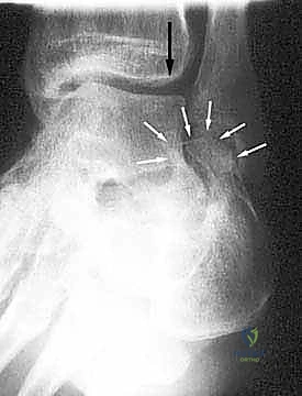 الخيارات التحفظية والأحذية المخصصة