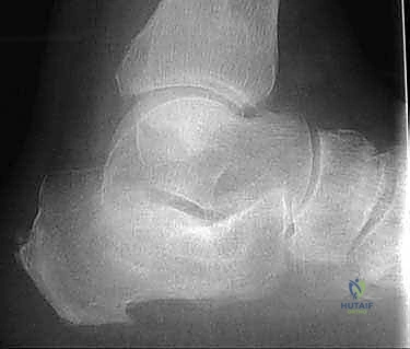 أعراض توسع الكعب وتسطح القدم