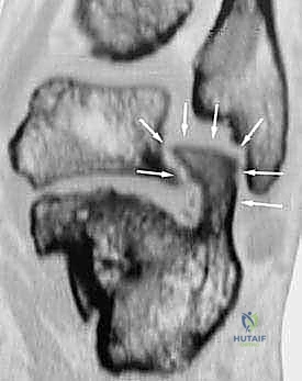 التأثير الميكانيكي للتحميل المبكر للوزن