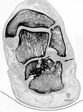 إتقان إعادة بناء سوء التئام عظم الكعب: دليل شامل للمرضى مع الأستاذ الدكتور محمد هطيف