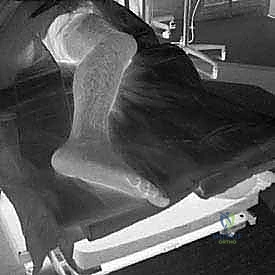 دور العلاج الطبيعي في المراحل الأولى