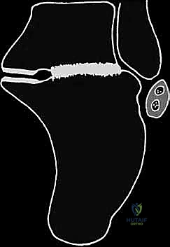 انحشار الأوتار والأعصاب بسبب التشوه