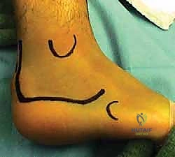 تنظيف المفصل تحت الكاحل وتجهيزه للدمج