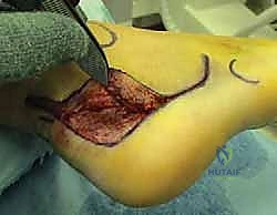 استخدام البراغي الطبية لتثبيت المفصل