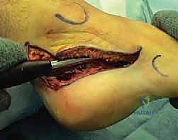 صورة توضيحية لـ إتقان إعادة بناء سوء التئام عظم الكعب: دليل شامل للمرضى مع الأستاذ الدكتور محمد هطيف