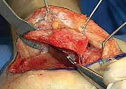صورة توضيحية لـ إتقان إعادة بناء سوء التئام عظم الكعب: دليل شامل للمرضى مع الأستاذ الدكتور محمد هطيف