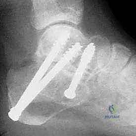 أهمية التأهيل ما بعد الجراحة