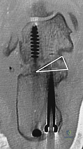 صورة توضيحية لـ إتقان إعادة بناء سوء التئام عظم الكعب: دليل شامل للمرضى مع الأستاذ الدكتور محمد هطيف