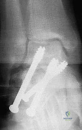 المرحلة الأولى من التأهيل والحماية