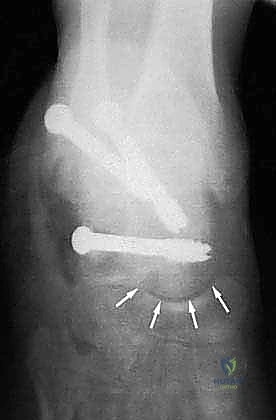 صورة طبية: إتقان إعادة بناء سوء التئام عظم الكعب: دليل شامل للمرضى مع الأستاذ الدكتور محمد هطيف
