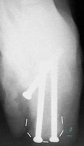 صورة توضيحية لـ إتقان إعادة بناء سوء التئام عظم الكعب: دليل شامل للمرضى مع الأستاذ الدكتور محمد هطيف