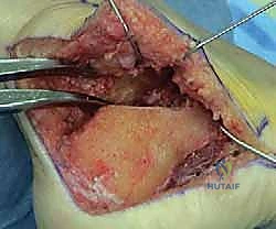 صورة طبية: إتقان إعادة بناء سوء التئام عظم الكعب: دليل شامل للمرضى مع الأستاذ الدكتور محمد هطيف