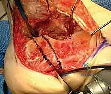 القطع العظمي التصحيحي للكعب