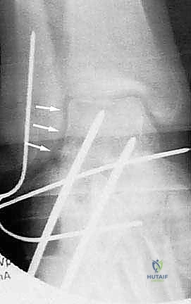 Illustration of lateral wall exostectomy - Dr. Mohammed Hutaif