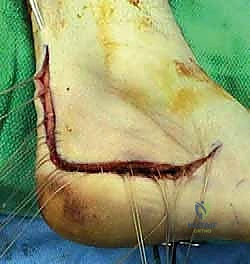 صورة توضيحية لـ إتقان إعادة بناء سوء التئام عظم الكعب: دليل شامل للمرضى مع الأستاذ الدكتور محمد هطيف