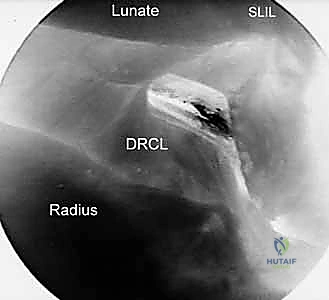 Arthroscopic Dorsal Radiocarpal Ligament Repair: An Intraoperative Masterclass
