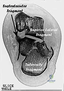 Masterclass: Corrective Calcaneal Osteotomy & Subtalar Arthrodesis for Malunion